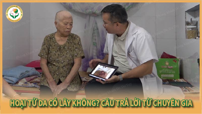Hoại tử da có lây không? Câu trả lời từ chuyên gia