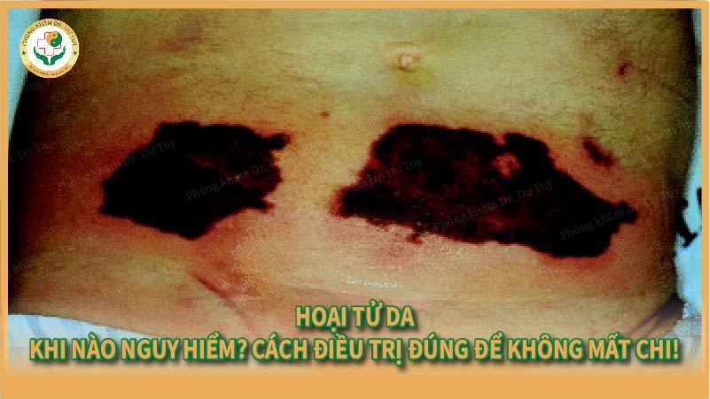 Hoại tử da: Khi nào nguy hiểm? Cách điều trị đúng để không mất chi!