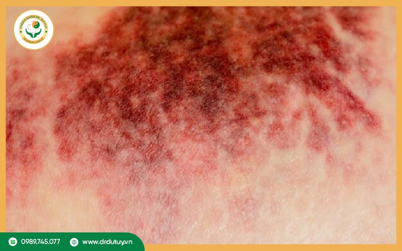Cách điều trị khi vết thương bị hoại tử