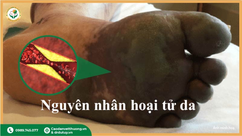 hoại tử khô