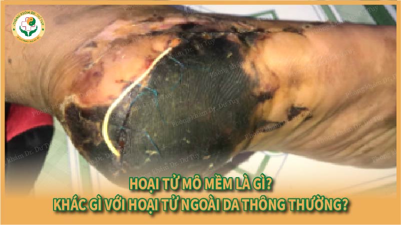 Hoại tử mô mềm là gì? Khác gì với hoại tử ngoài da thông thường?