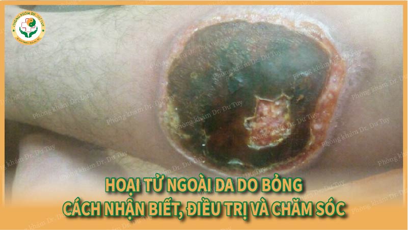 Hoại tử ngoài da do bỏng – Cách nhận biết, điều trị và chăm sóc