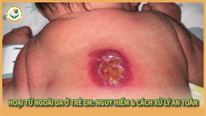 Hoại tử ngoài da ở trẻ em: Nguy hiểm & cách xử lý an toàn