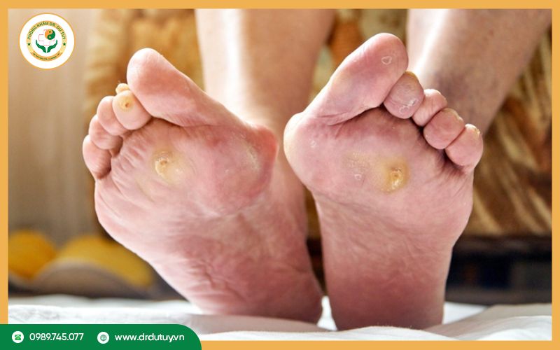 Hoại tử ngón chân: Nguyên nhân và cách xử lý ngón chân hoại tử