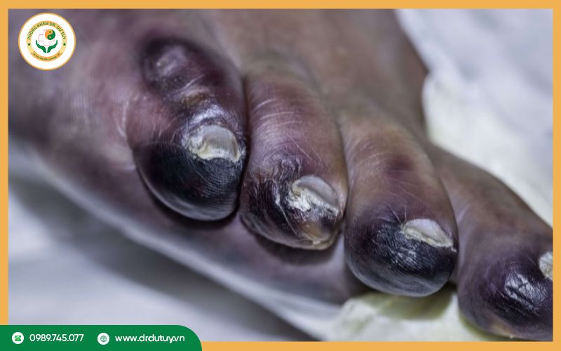 Hoại tử ngón chân là gì?