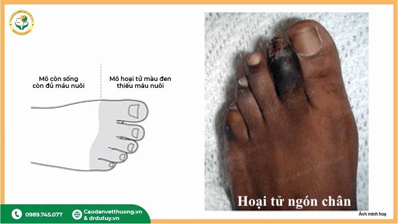hoại tử ngón chân thiếu máu nguy cơ cắt cụt 