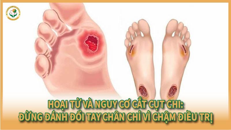 Hoại tử và nguy cơ cắt cụt chi: Đừng đánh đổi tay chân chỉ vì chậm điều trị