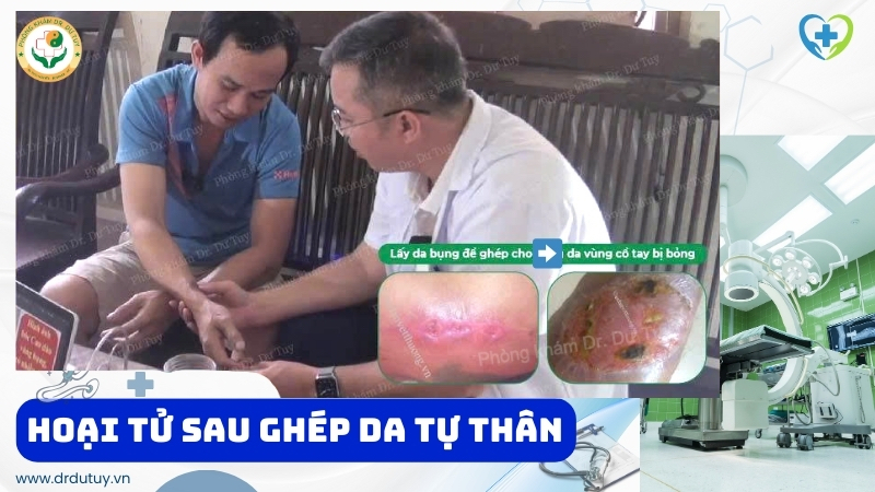hoại tử sau ghép da tự thân