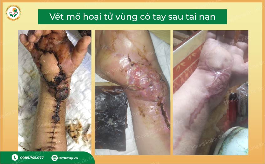 hoại tử sau ghép da