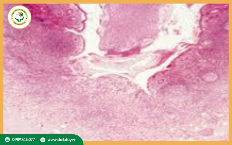 Hoại tử tơ huyết là gì? Nguyên nhân, triệu chứng và cách điều trị hiệu quả