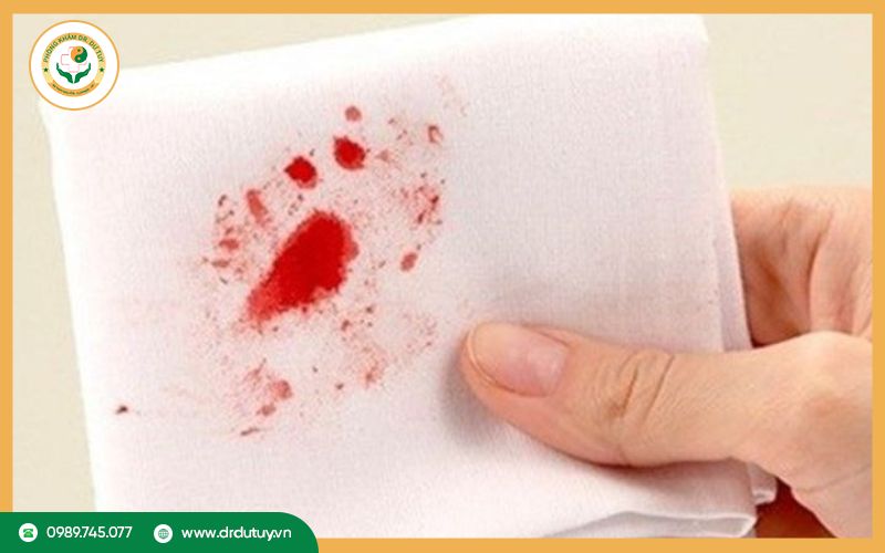 Dấu hiệu của hoại tử tơ huyết