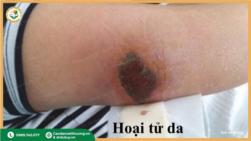 hoại tử ướt