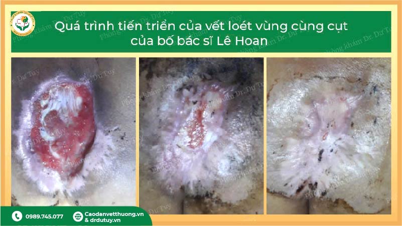 hồi phục lở loét vùng cùng cụt sau dán cao