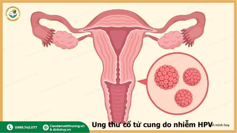 HPV 16 18 gây ung thư cổ tử cung