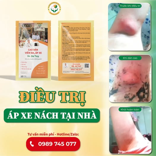 Hướng dẫn điều trị áp xe nách tại nhà hiệu quả