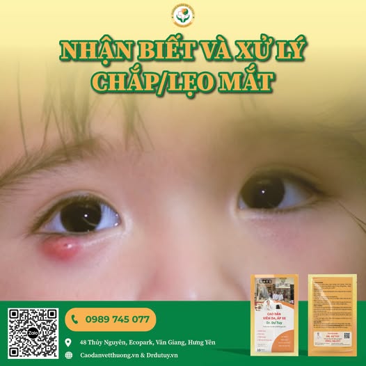 Hướng dẫn điều trị chắp/ lẹo mắt tại nhà an toàn, hiệu quả
