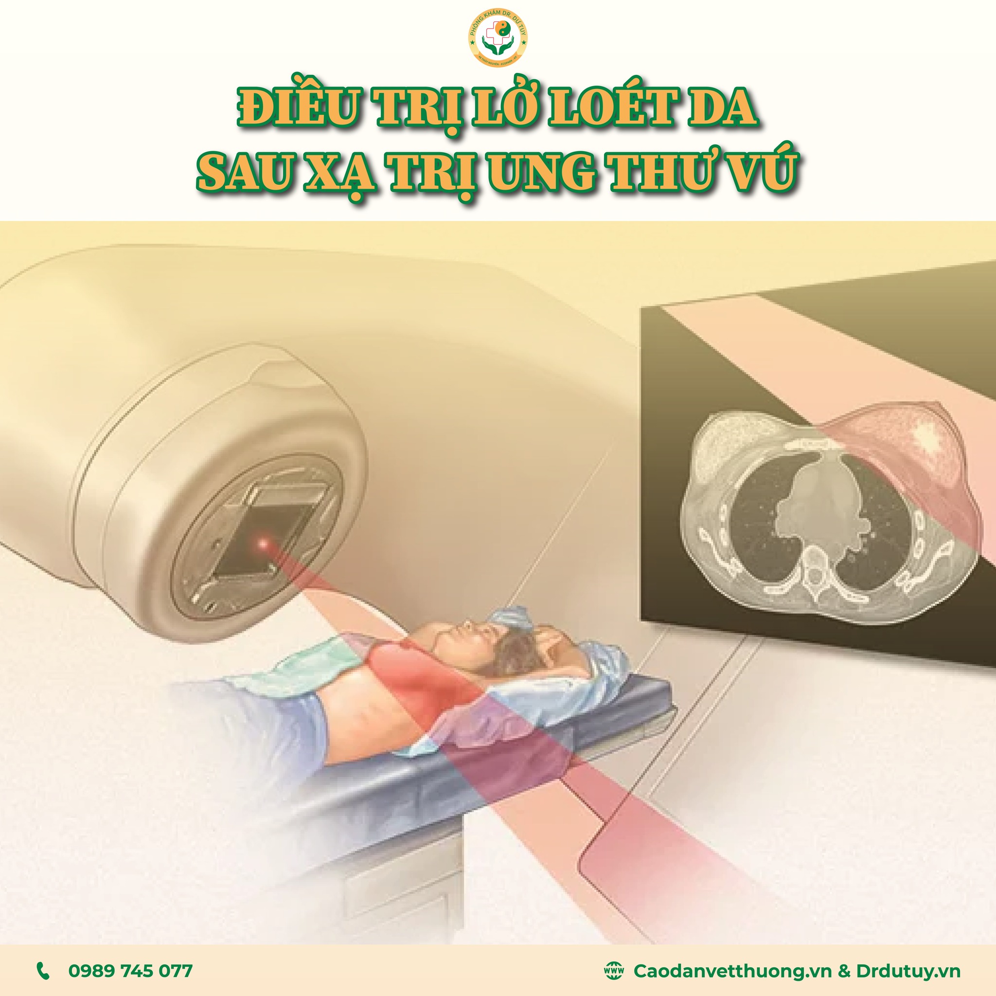Hướng dẫn điều trị lở loét da sau xạ trị ung thư vú