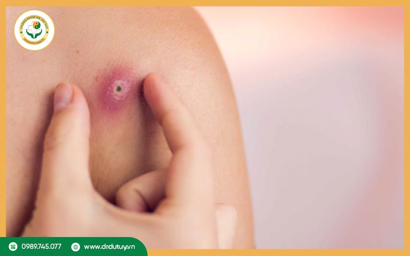 Cách hút mủ mụn nhọt nhanh nhất, lành tính và tránh nhiễm trùng da