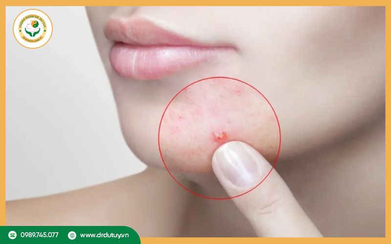 Lưu ý khi tự hút mủ mụn nhọt tại nhà