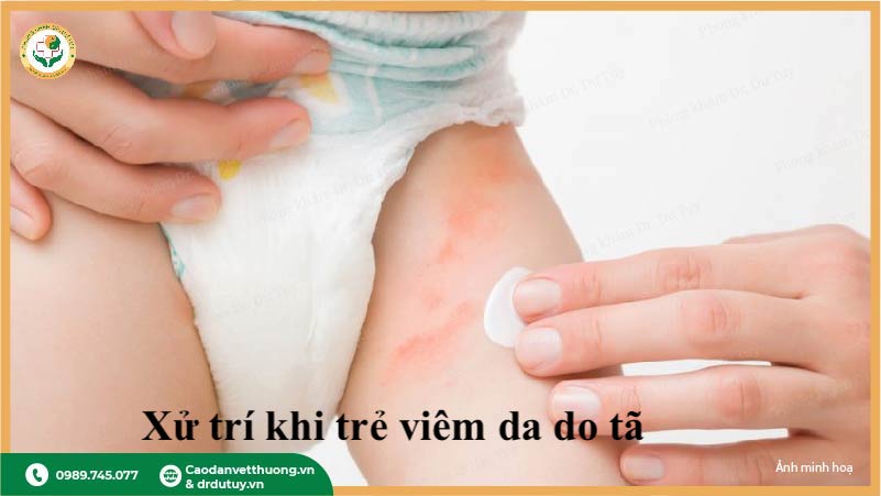 kem chống hăm cho bé