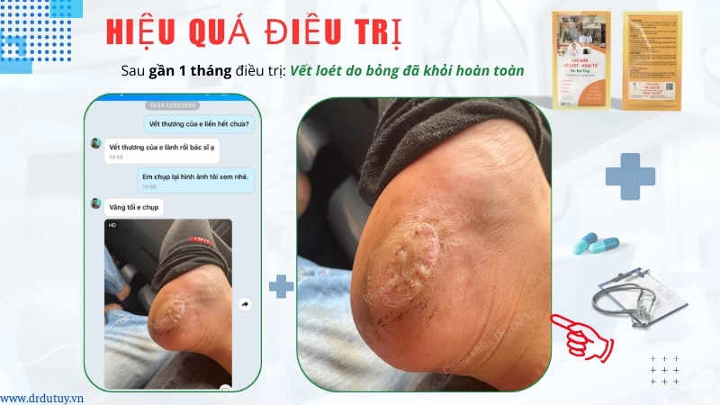 kết quả điều trị lở loét gót chân khôi phục hoàn toàn