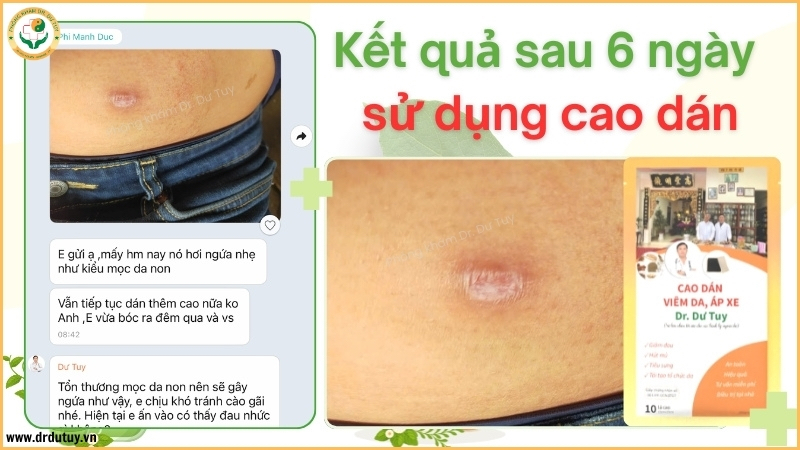 kết quả ổ áp xe sau 6 ngày theo dõi