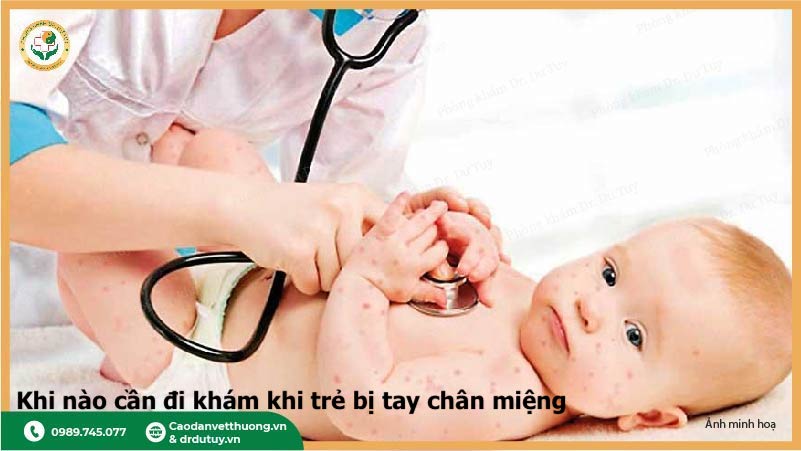khám bệnh tay chân miệng ở trẻ nhỏ