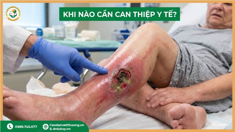 khi nào cần can thiệp y tế vết loét chảy mủ