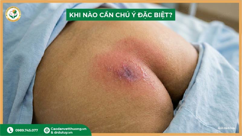 khi nào cần chú ý đặc biệt vùng cùng cụt