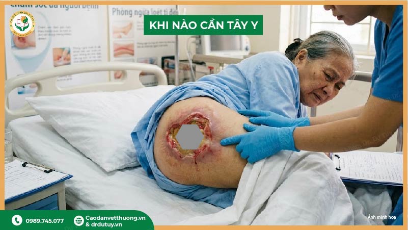 khi nào cần tây y chữa loét tỳ đè