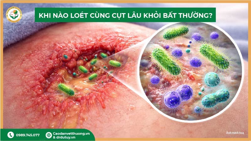 khi nào loét cùng cụt lâu khỏi bất thường