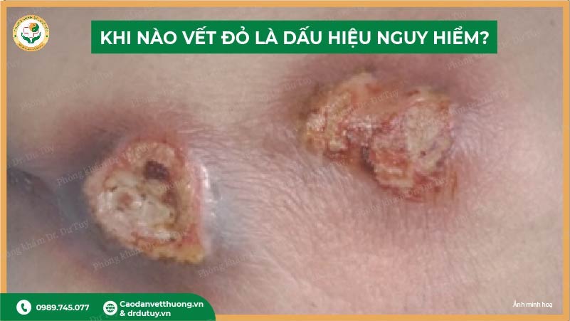 khi nào vết đỏ vùng cùng cụt là dấu hiệu nguy hiểm