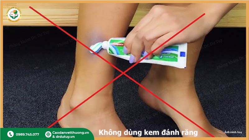 không bôi kem đánh răng lên vết bỏng