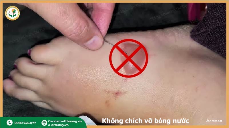 không chích vỡ bọng nước khi bị bỏng