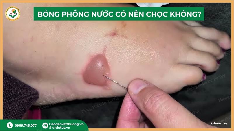 không nên chọc bỏng phồng nước