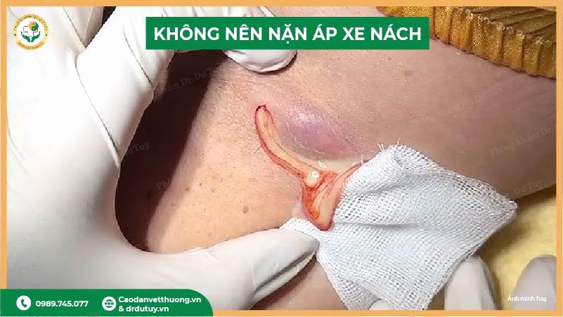không nên nặn áp xe nách
