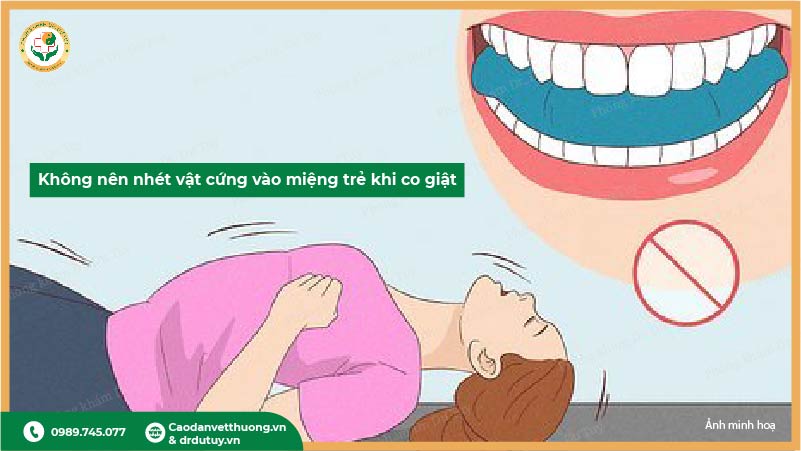 không nên nhét vật cứng vào miệng trẻ khi co giật