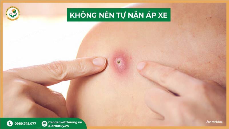 không nên tự nặn áp xe tại nhà