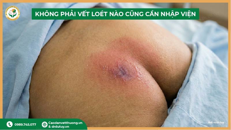 không phải vết loét nào cũng cần nhập viện