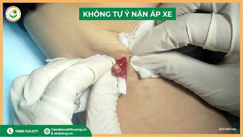 không tự ý nặn áp xe nách