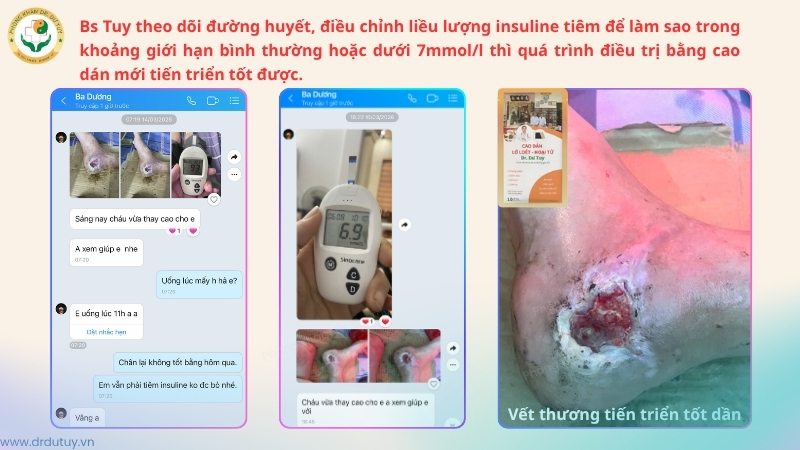 kiểm soát đường huyết điều trị vết thương gót chân tiểu đường