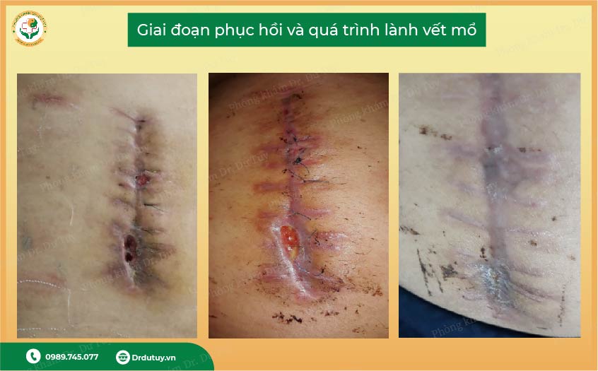 làm lành vết mổ nhanh