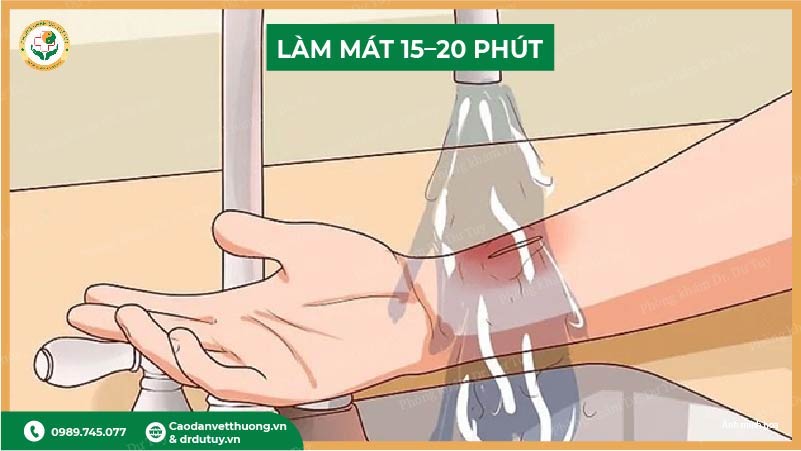 làm mát vết bỏng 15- 20 phút