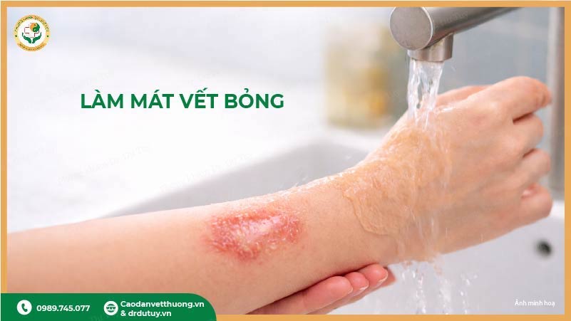 làm mát vết bỏng dưới vòi nước mát