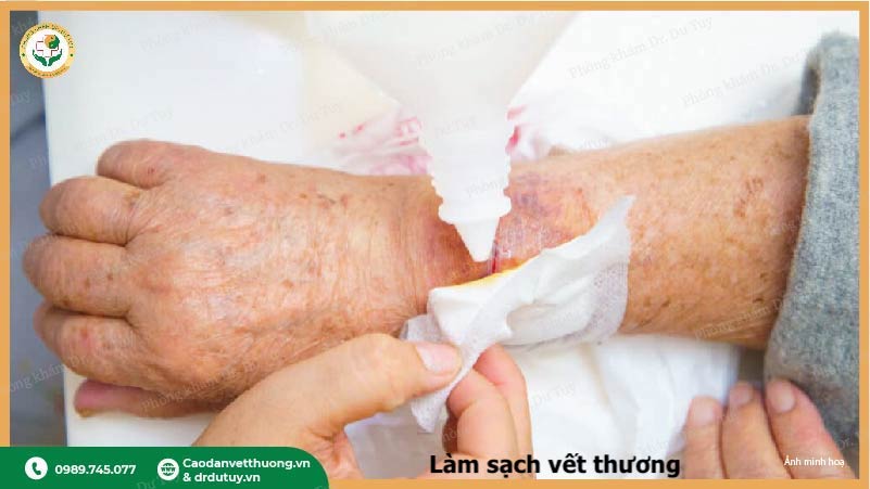 làm sạch vết loét loại bỏ mô chết
