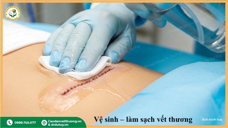làm sạch vết loét sau phẫu thuật đúng cách