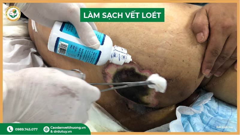 làm sạch vết loét tì đè