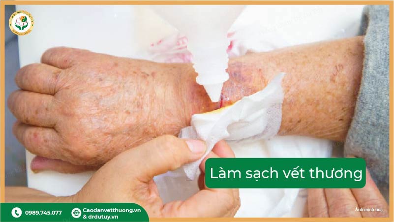 làm sạch vết thương hở