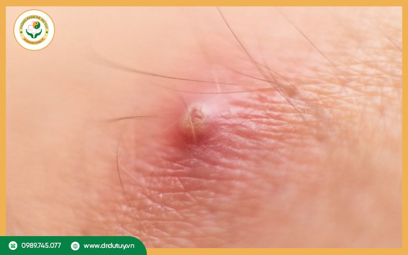 Làm sao để biết mụn nhọt chín? 5 dấu hiệu nhận biết chính xác