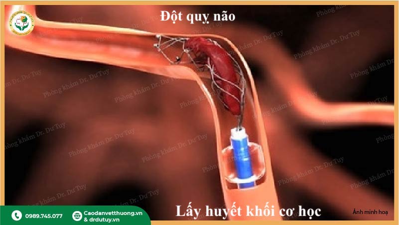 Lấy huyết khối cơ học